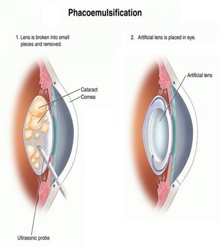 Phacoemulsification