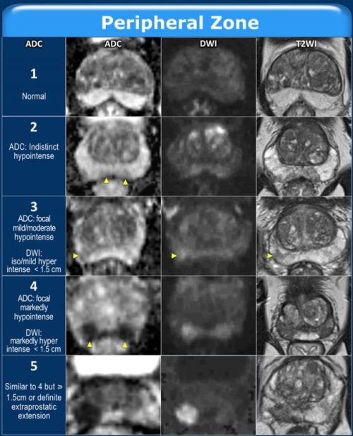 PI RADS Prostate Imaging Reporting And Data System