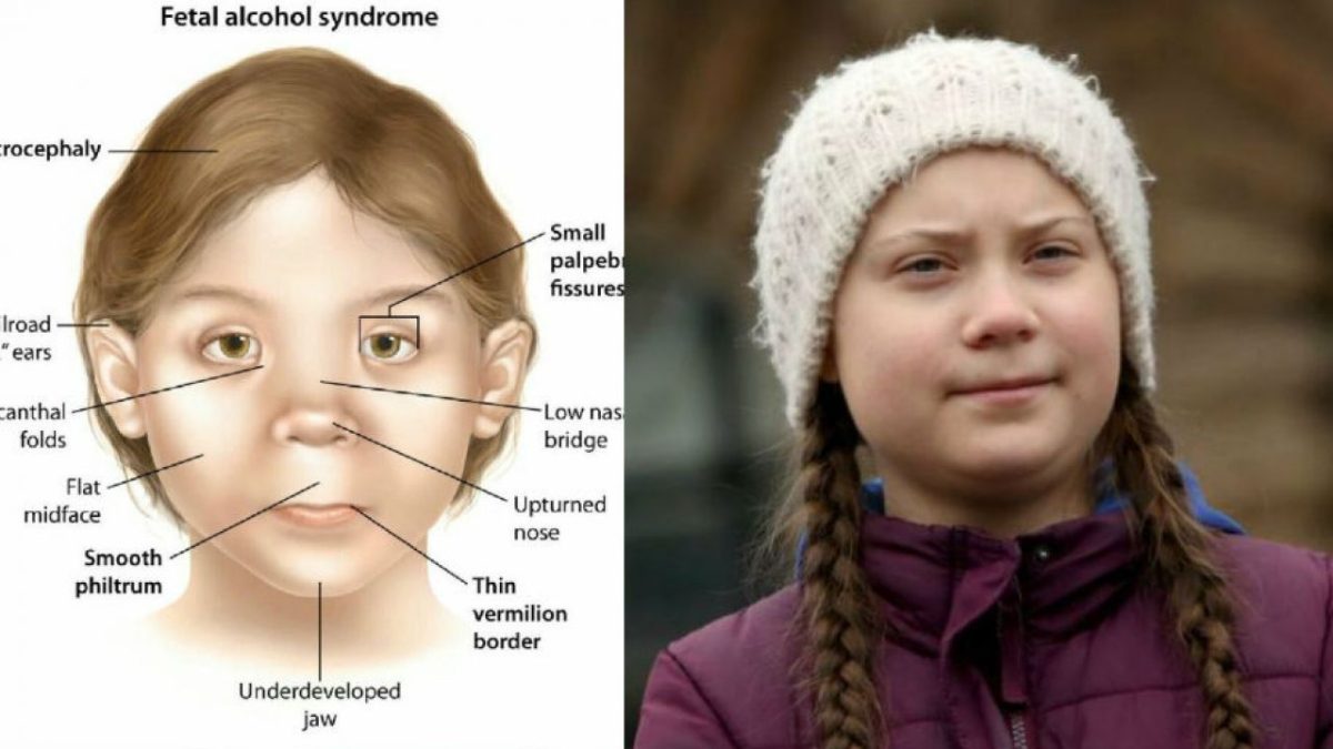 Fetal alcohol syndrome