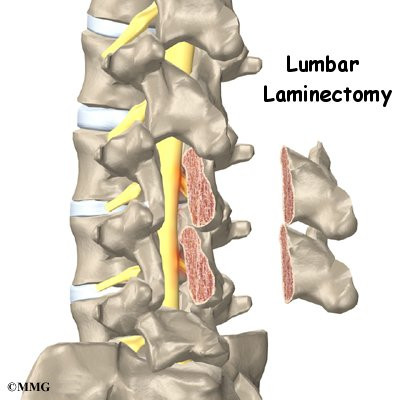 Laminectomy