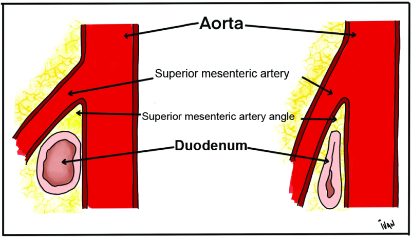 Sma Compression Superior mesenteric artery syndrome