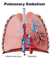 Pulmonary embolism/embolus