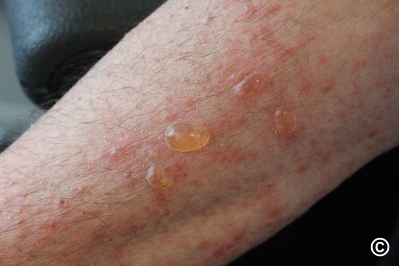 Bullous Pemphigoid