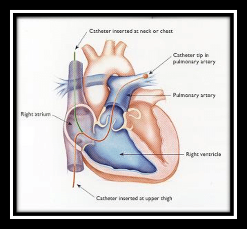 Right heart catheterization