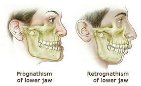 Historical Nonfiction — Pathologic mandibular prognathism, or