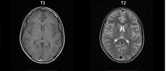 T1 weighted images