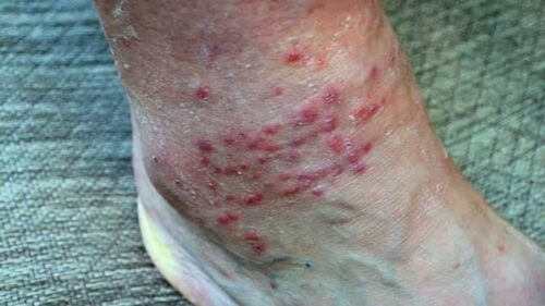 Chiggers