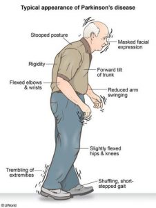 Parkinson’s disease