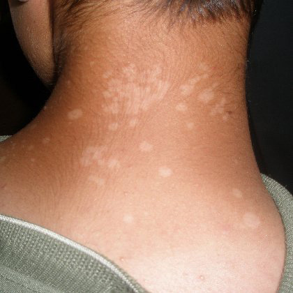 Skin Concerns] Have y'all ever seen tinea versicolor this bad