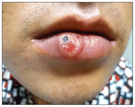 Mild Syphilis Chancre mild-syphilis-chancre