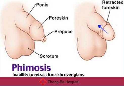 Types of phimosis. Inability to retract the foreskin covering the
