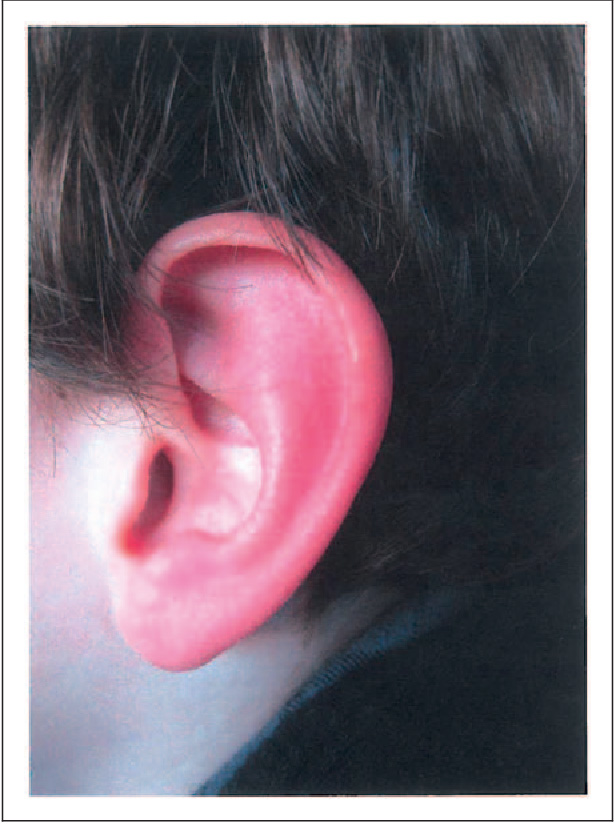 Pind debitor arbejde Red ear syndrome