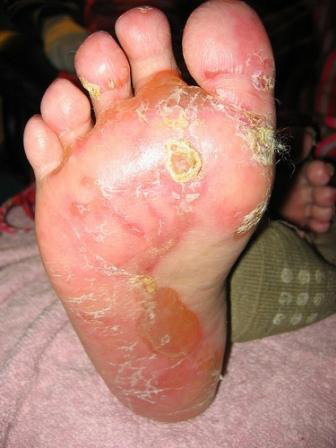 Hand foot syndrome (palmar-plantar erythrodysesthesia)