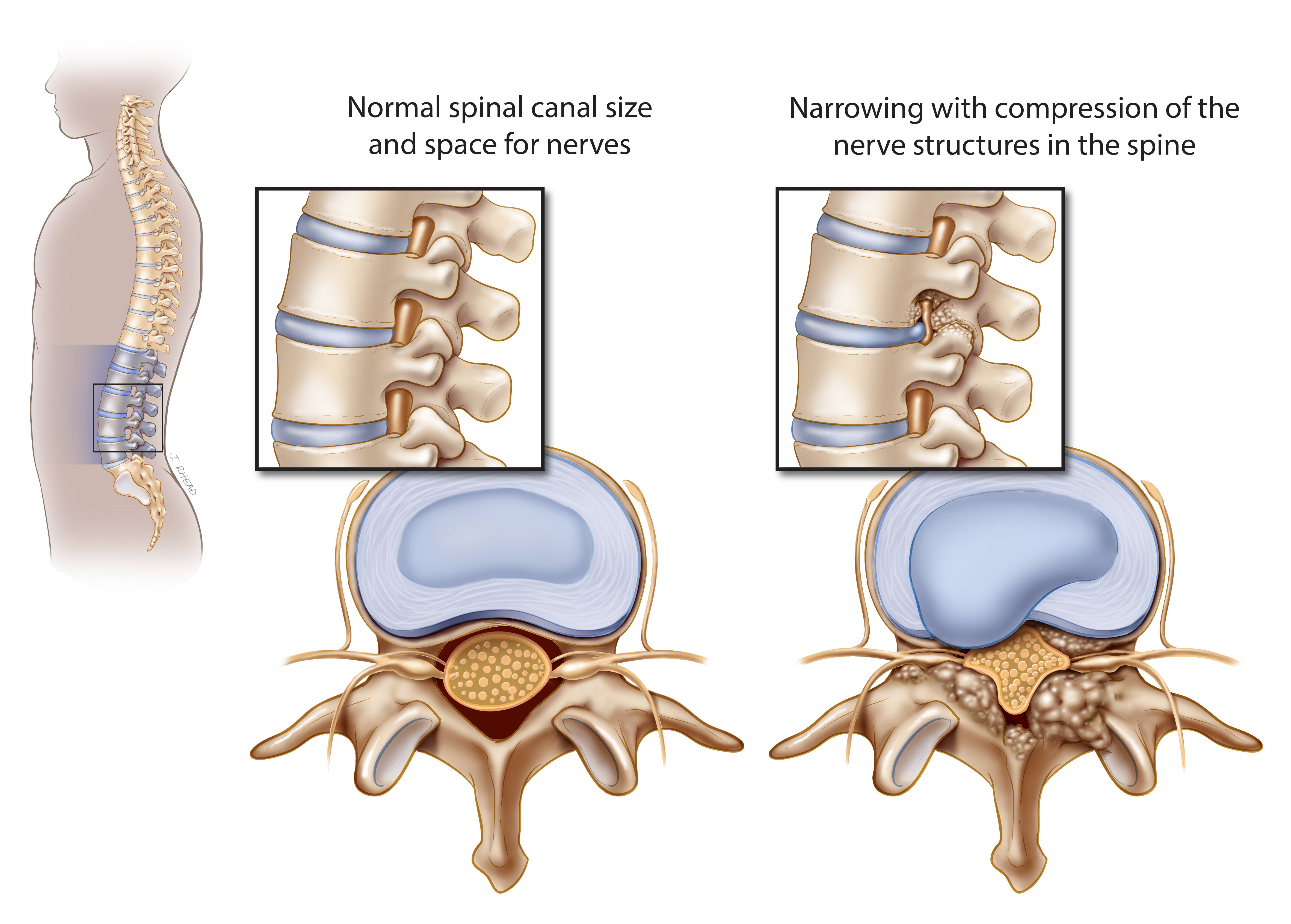 Поясничные диски. Имплант межпозвонкового диска поясничного отдела. (Lumbar Spinal Stenosis. Имплантация позвонка поясничного отдела. Spinal canal Stenosis.