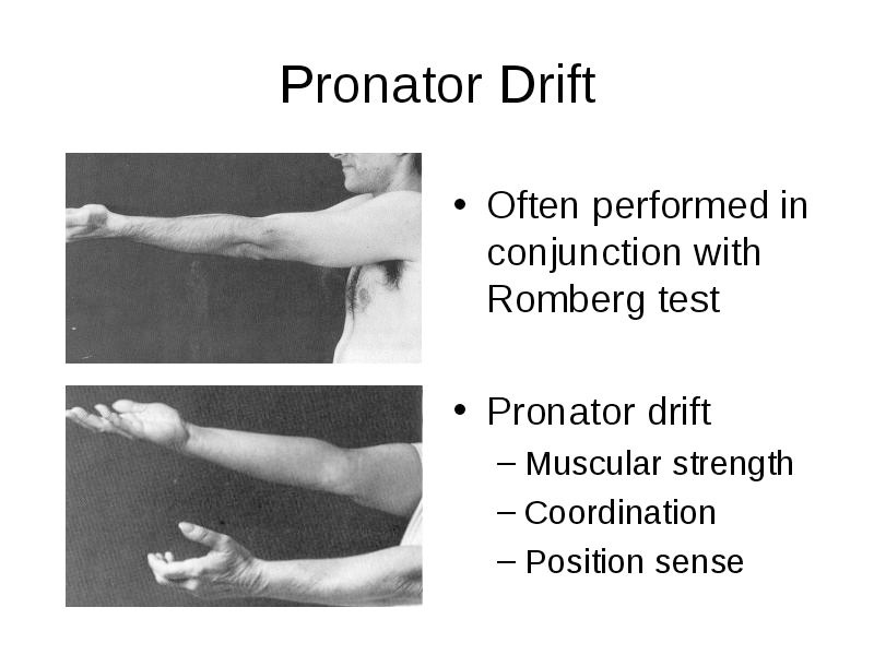 What Is Pronator Drift