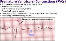 premature ventricular contraction ecg